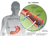 CBD a cukrovka - diabetes 1.typu